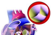 TAVI : l’innovation cardiaque se rapproche des patients